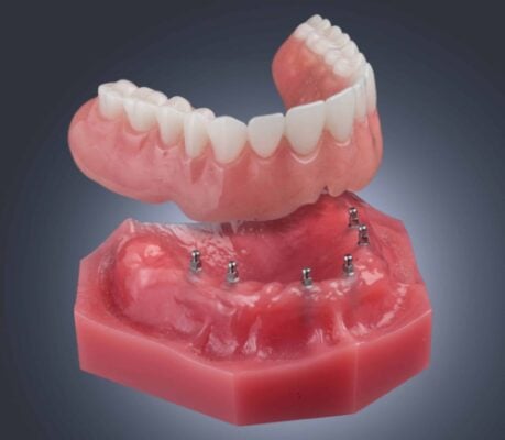 Floating Dentures | Mini Dental Implants in North Carolina