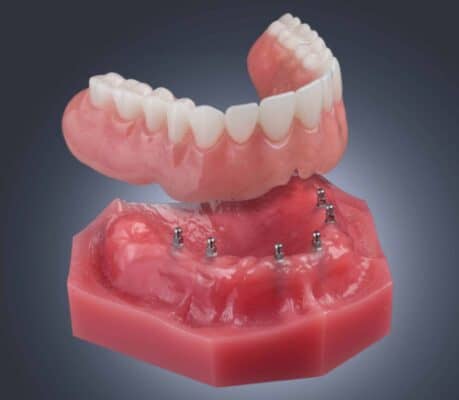 Dentures vs. Implants in Scottsdale, Arizona