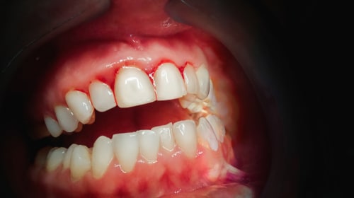 Silent Threat: Unveiling the Dangers of Periodontal Disease