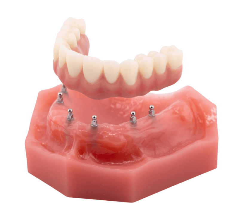 All on Four | Implant Dentures in Butler, PA | Brockley Dental Center