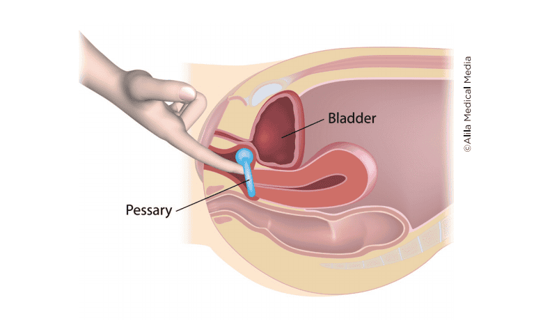 Prolapse pessary Vaginal Pessaries - Brazosport Women's Health