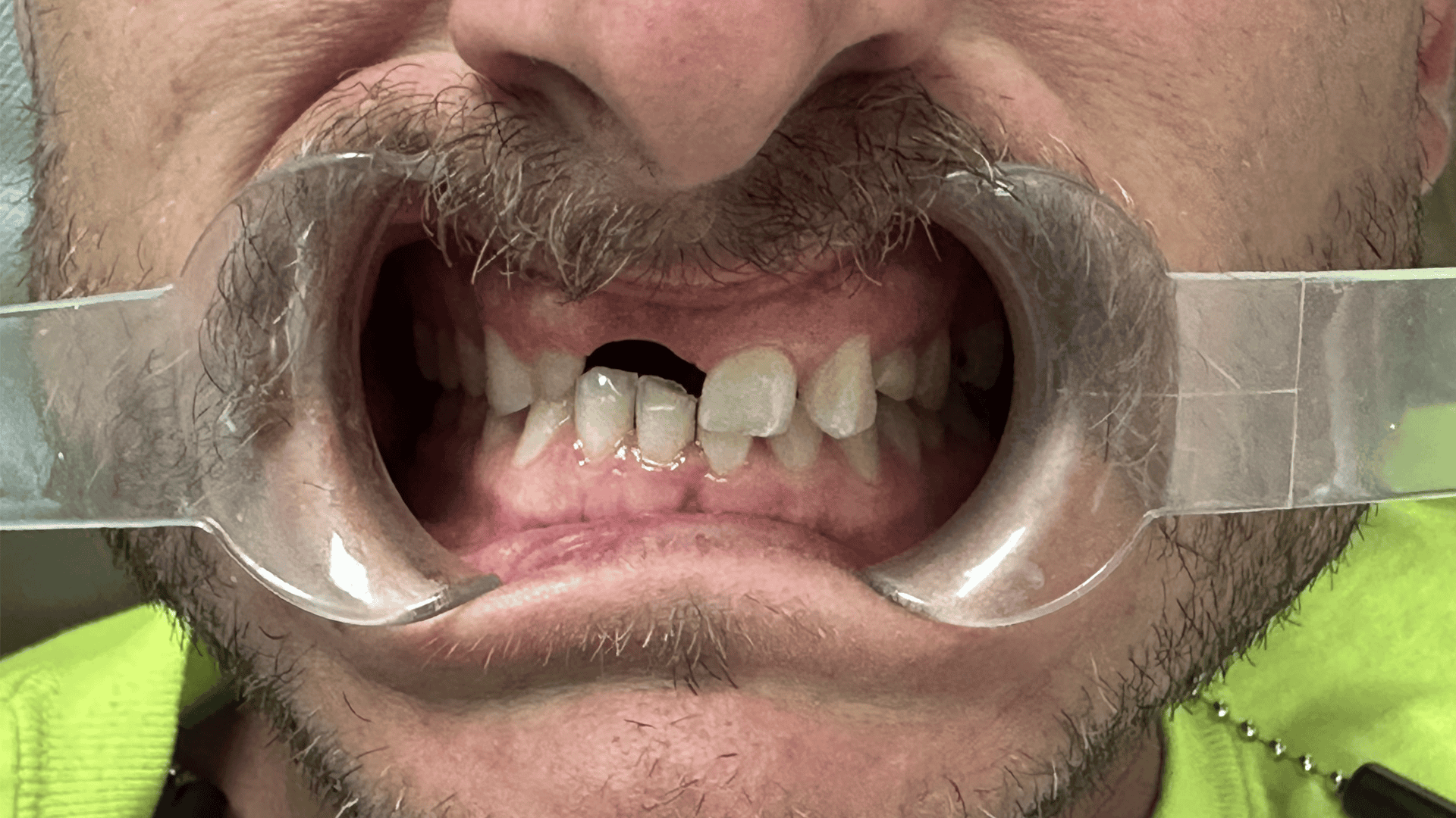 Mini Dental Implants in Scottsdale, AZ Dr. Seerat Mann