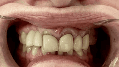 Mini Dental Implants in Scottsdale, AZ Dr. Seerat Mann