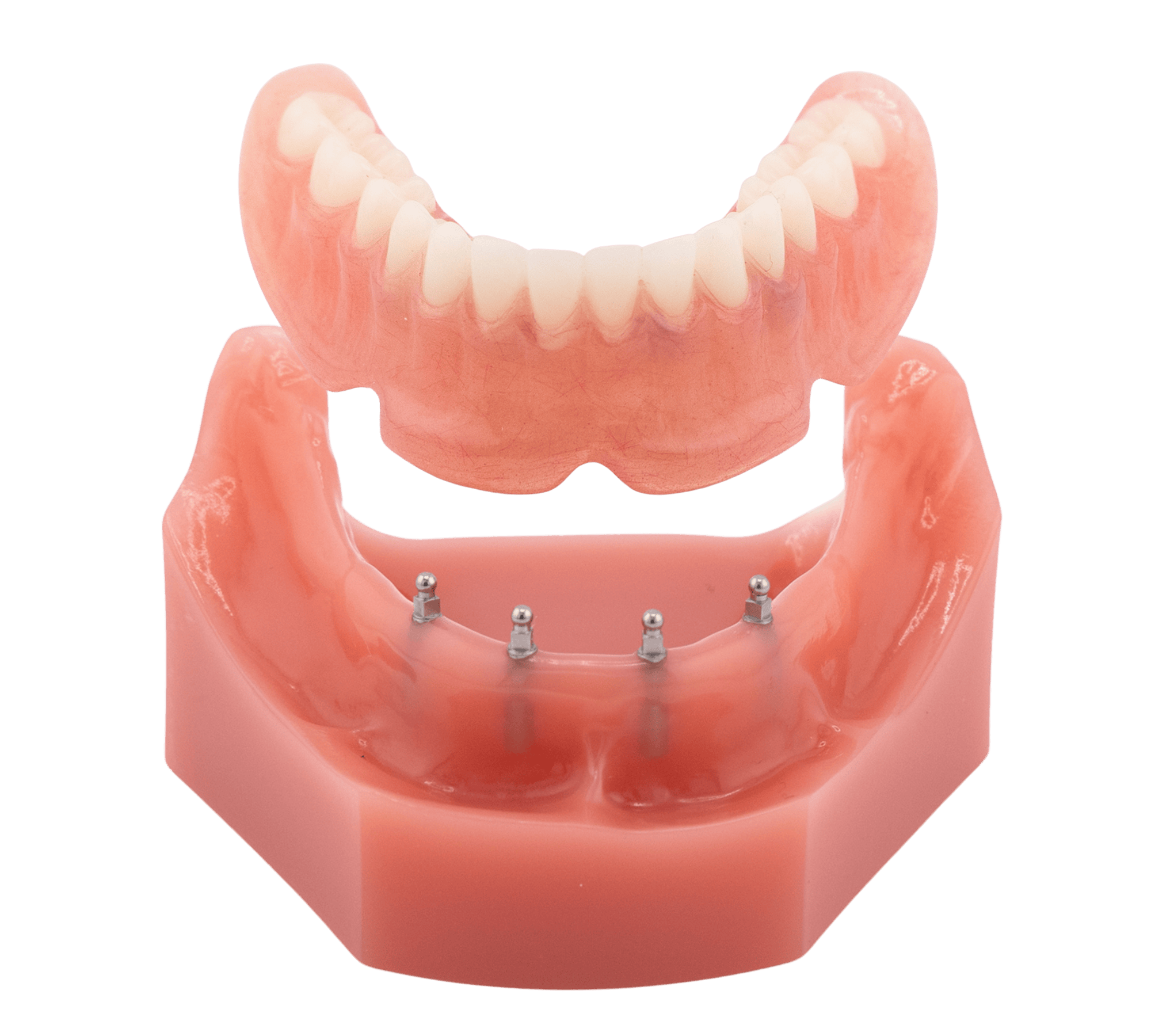 Snap-In Dentures in Union City, NJ | How Mini Dental Implants Stabilize Loose Dentures | Understanding Denture Alternatives | Diana Rodriguez & Associates