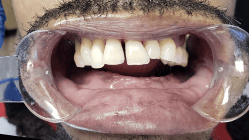 Mini Dental Implants in Scottsdale, AZ Dr. Seerat Mann