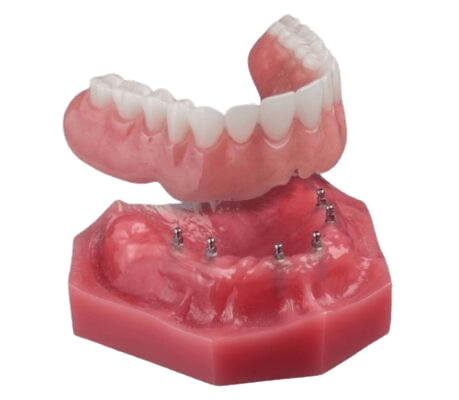 Snap-On Dentures in Sterling Heights, MI | Free Consultations