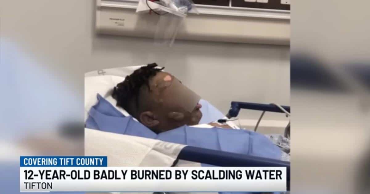 A 12-year-old boy lies in a hospital bed, his face and upper body visibly burned. He is covered with bandages and medical equipment. The image is from a news report about a "boiling water stunt" sleepover incident in Tifton, Georgia where the boy suffered severe burns.