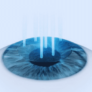 Lasermethoden 1 Smart_Surface