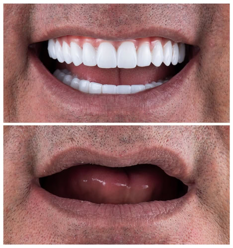 Mini Implants in Sullivan County, NY | Book a Free Consultation!