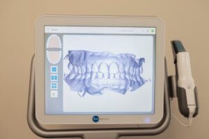 Itero Scanner Invisalign