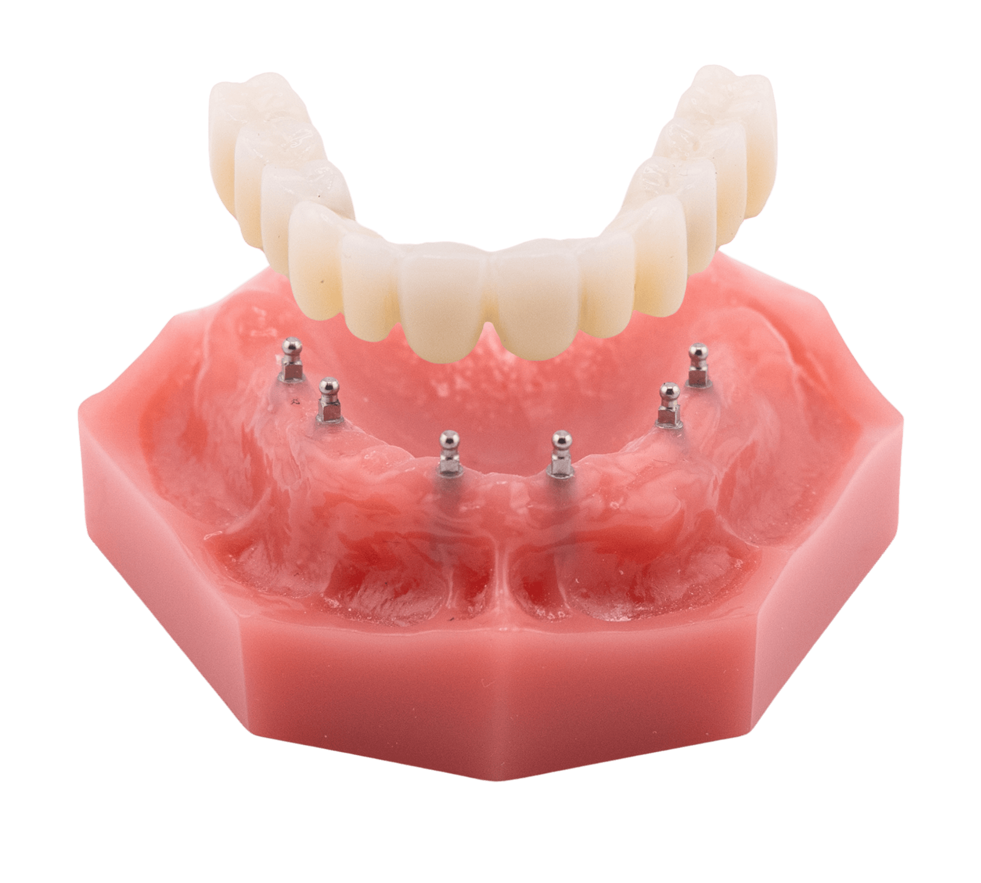 Full-Arch Dental Implants in Springfield, MO | Free Consultations