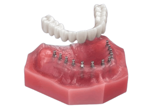 Roundhouse Bridge | Mini Implant Dentures in Union City, NJ