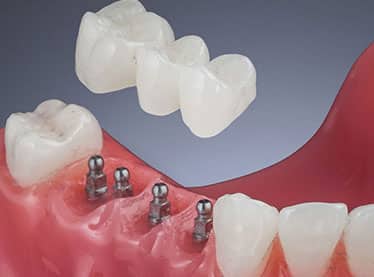Dental Bridges in Scottsdale, AZ