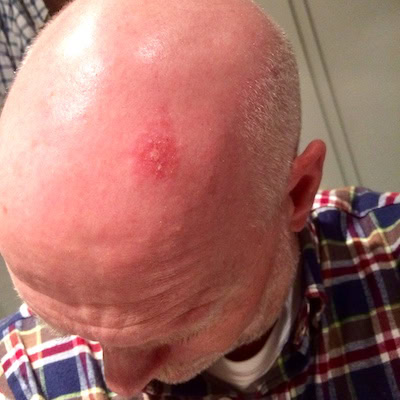 Aktinische Keratose Foto - Folgeschaden