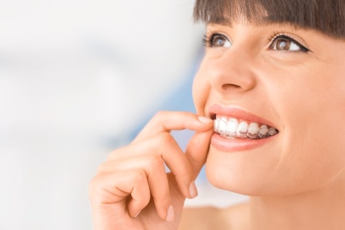 Invisalign in Dallas, TX  Clear Aligners  Invisible Braces
