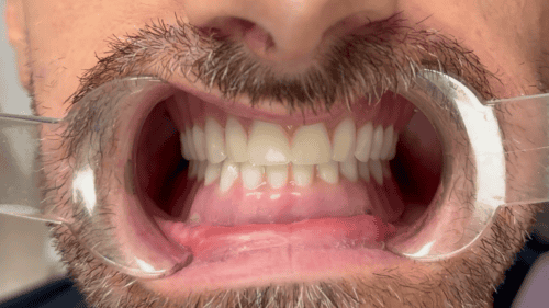 Mini Dental Implants in Scottsdale, AZ Dr. Seerat Mann