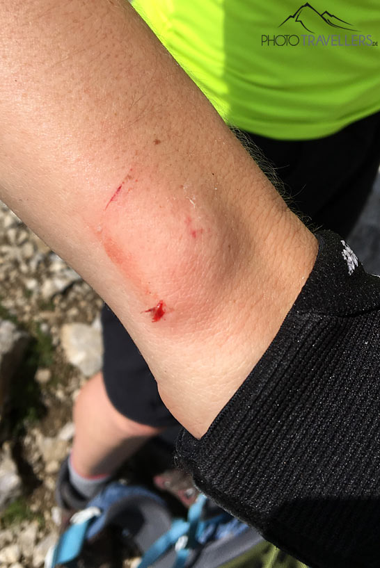 Ein blutiges Handgelenk, getroffen von einem Stein beim Wandern