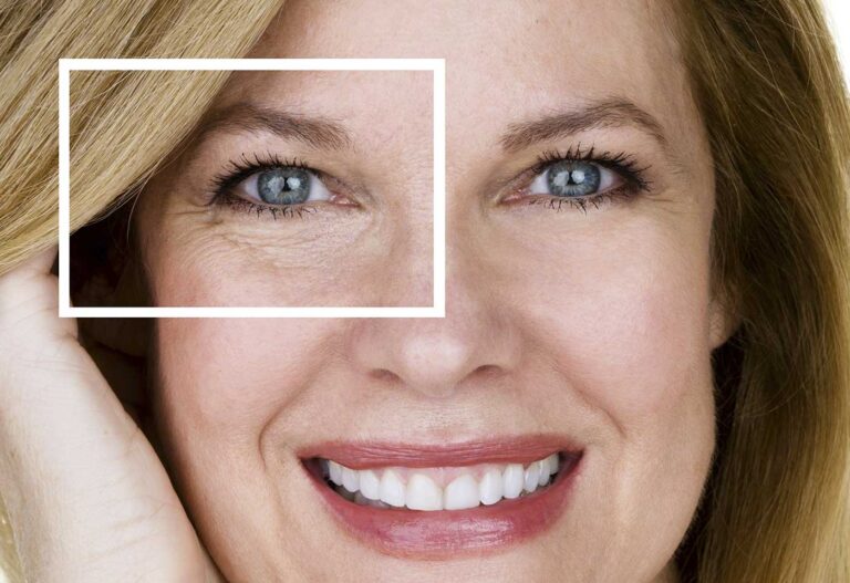 Blépharoplastie (chirurgie des paupières) supérieure