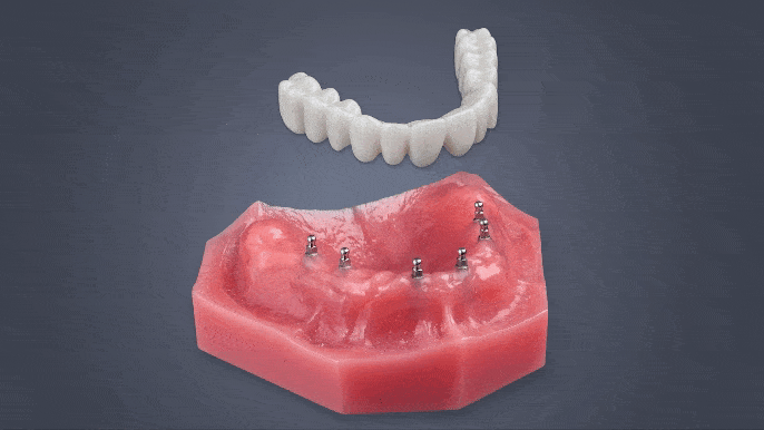 Fix-on-Six in Wayne, NJ | Book a Free Implant Consultation Today!