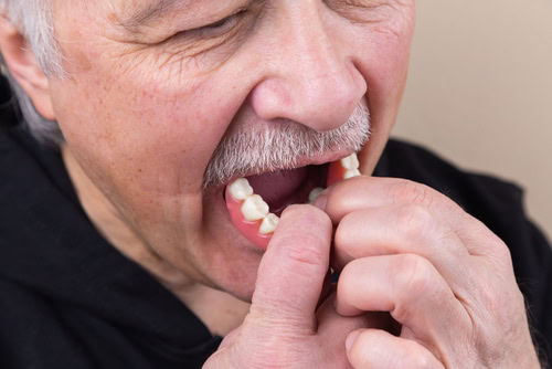 Denture Alternatives | Union City Implant Dentist Explains