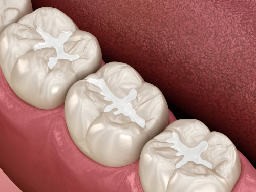 Dental Sealants for Adults in Dunn, NC | Protect Your Smile 🦷