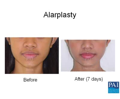alarplasty1_mini