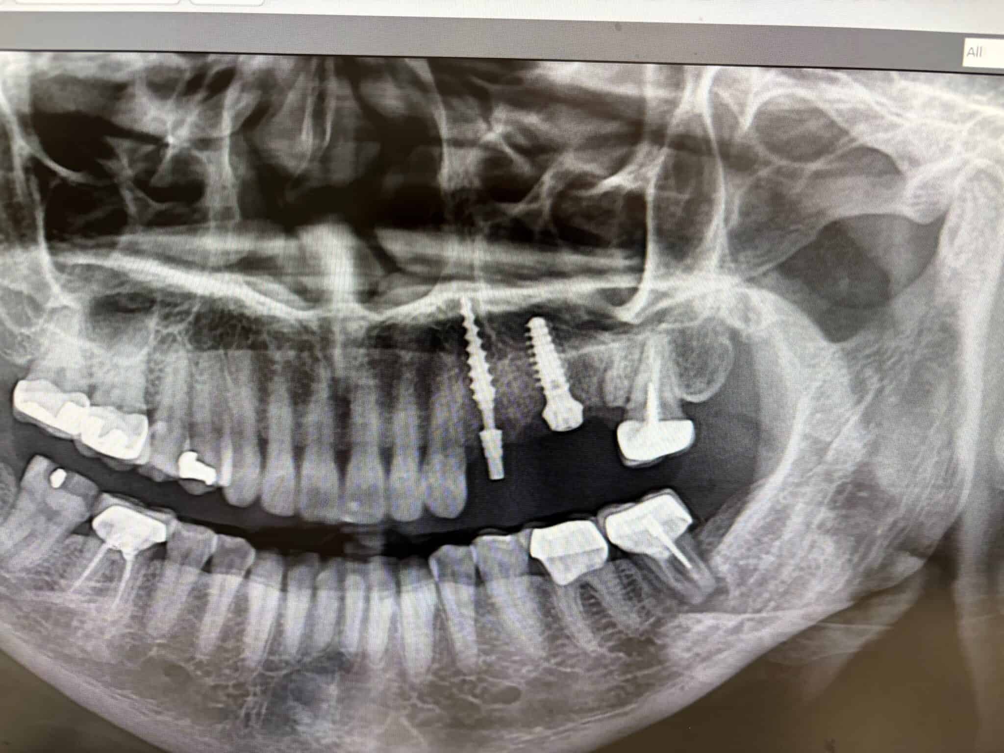 Screwless Dental Implants in Las Vegas, NV Patient X-Ray