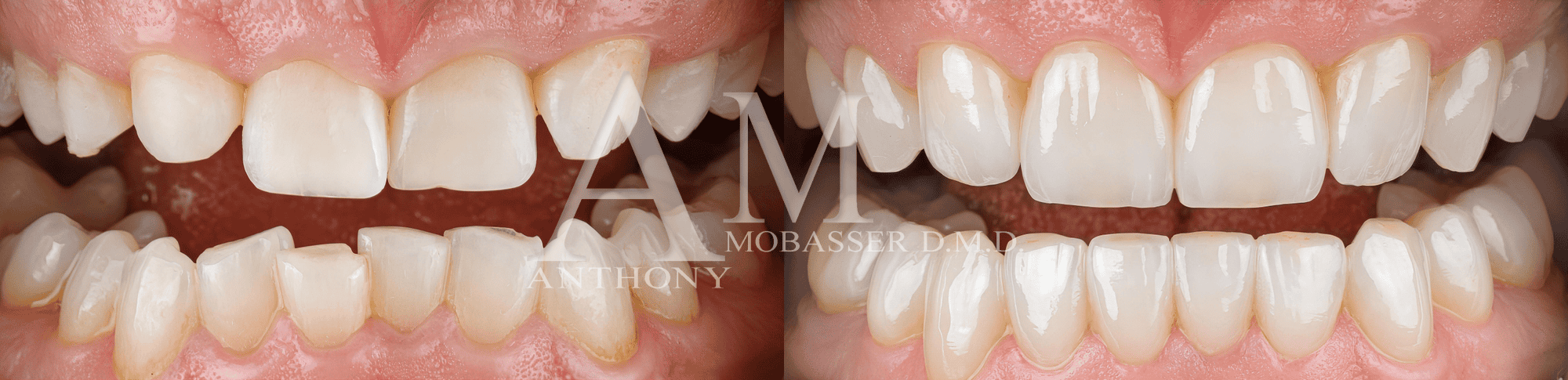 Full Mouth Reconstruction for Grinding | Before and After