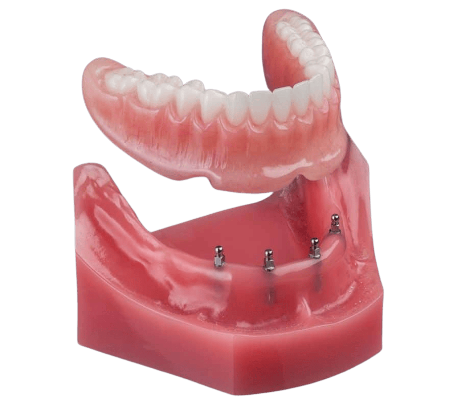 Snap-In Dentures in Wayne, NJ | Mini Dental Implants | Dr. Fine