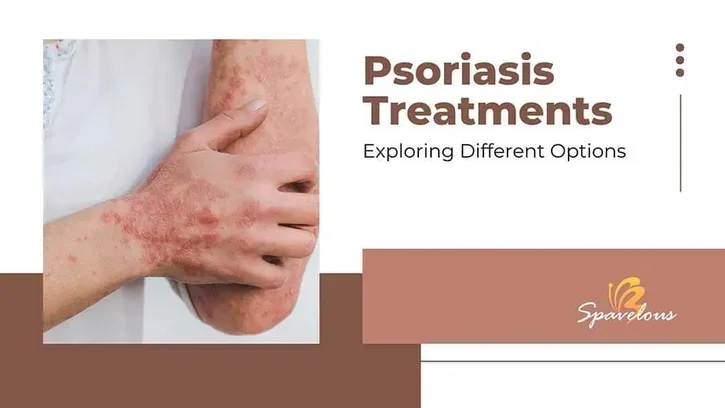 psoriasis treatments 101