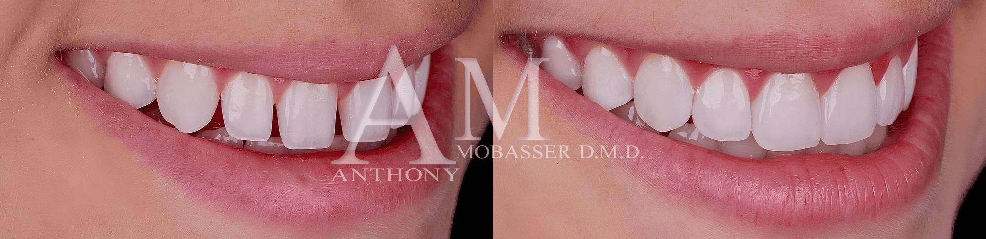 Emax Lumineers Before and After | Los Angeles Cosmetic Dentist