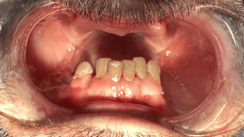 Mini Dental Implants in Scottsdale, AZ Dr. Seerat Mann
