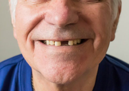 Tooth Loss in Wayne, NJ | New Teeth | Mini Implants | Dr. Fine
