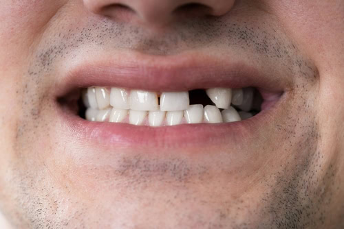 Missing Teeth | Implant Dentist | Diana Rodriguez and Associates
