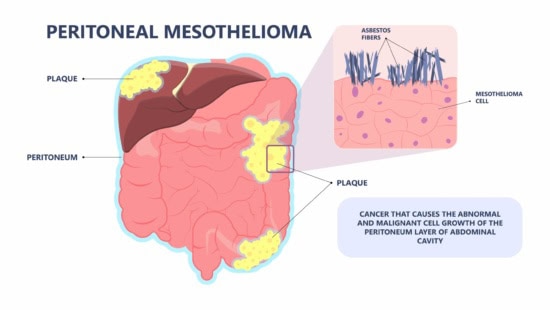 Peritoneal Mesothelioma Lawyers Lipsitz, Ponterio & Comerford, LLC