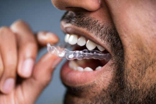 Clear Aligners En Gulfport, MS | Odontología Cosmética | Invisalign