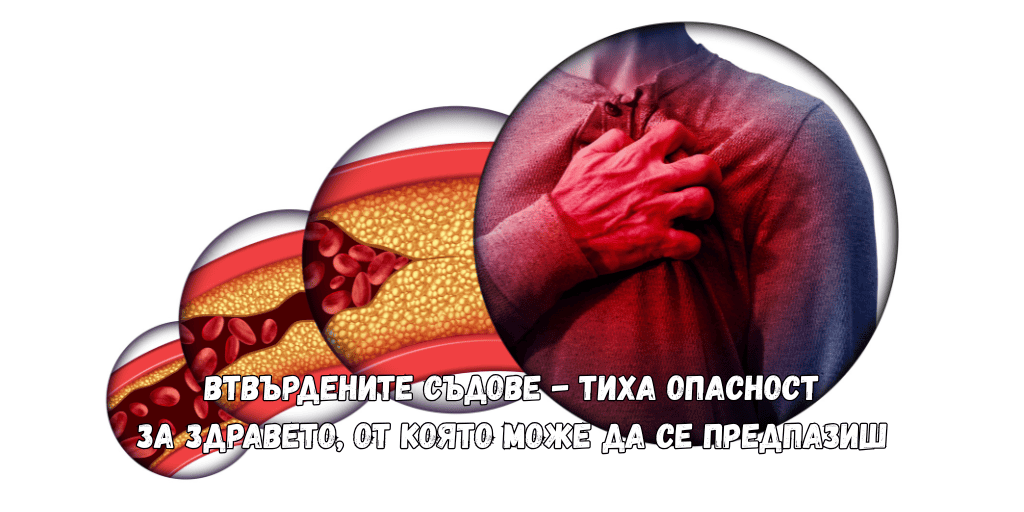 Атеросклероза
