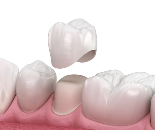 Same-Day Crowns vs. Lab-Made Crowns | Union City Dentist