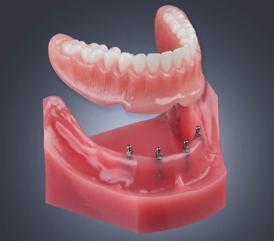 Denture Stabilization in Cleveland, TN | Mini Implants | Dr. Beard