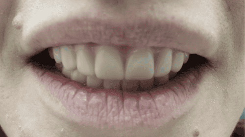 01 Before Mini Dental Implants in Scottsdale, AZ Dr. Seerat Mann