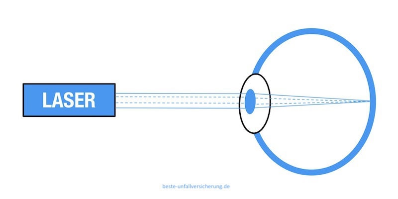 Lasertag - Abbildung eines Laserstrahls auf der Netzhaut