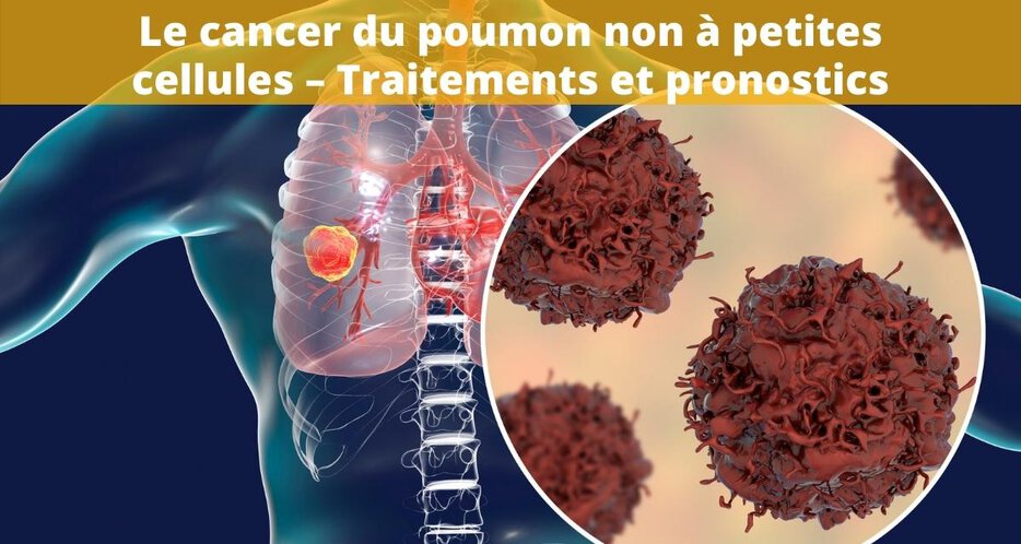 Symptômes et traitements du cancer du poumon non à petites cellules