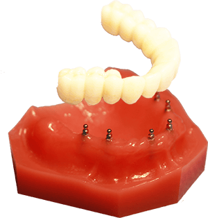 All-on-4 Alternatives in Gulfport, MS | Fix-on-Six | Mini Implants