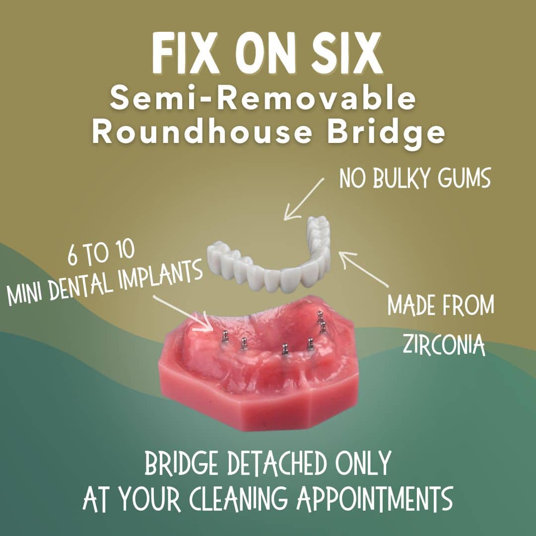 Dentadura postiza sobre implantes Fix On Six en San Francisco East Bay
