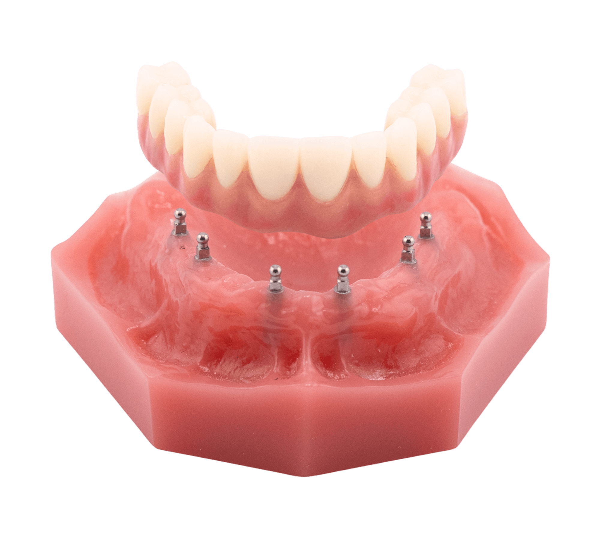 Denture Implants in Kaysville, UT | Book a Free Consultation
