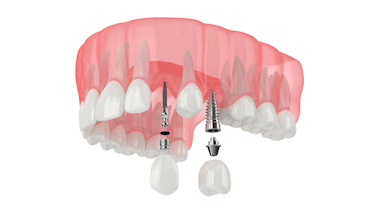 Mini Dental Implants in Bergen County, NJ | Free Implant Consults