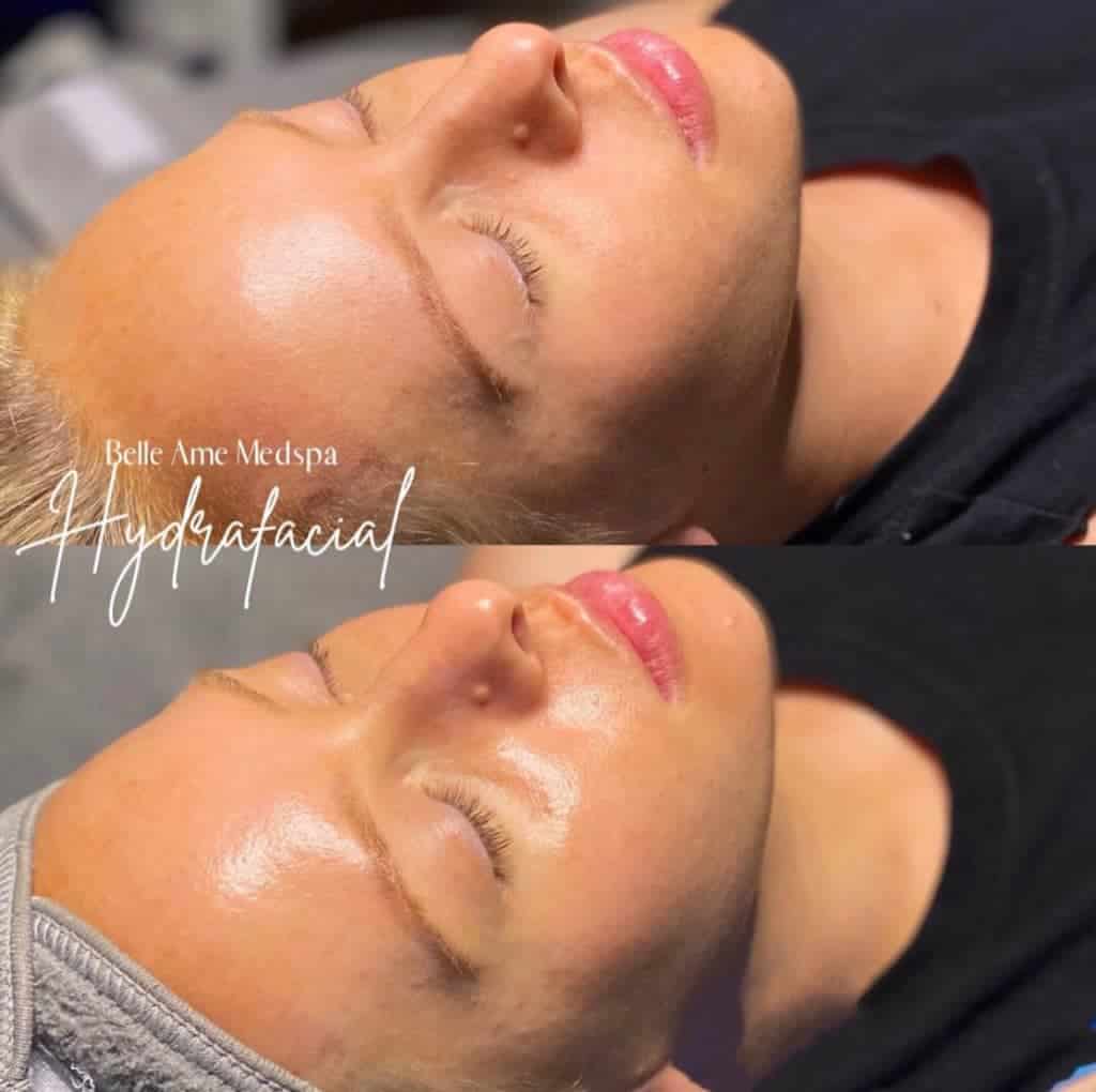 hydrafacial before and after1 1024x1020 before and after Dermaplane Facial OKC