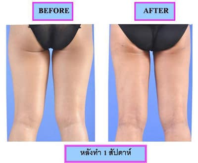 vaser-liposuction4_mini