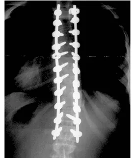 drjustintrosclair.com%2Fwp content%2Fuploads%2F2023%2F05%2Ffused spine