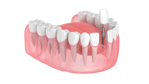 Implantes Dentales el Mismo Dia en Wayne NJ | Reserve una Consulta Gratuita